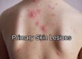 Primary Skin Lesions