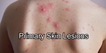 Primary Skin Lesions