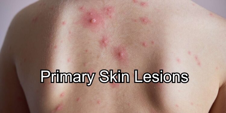 Primary Skin Lesions